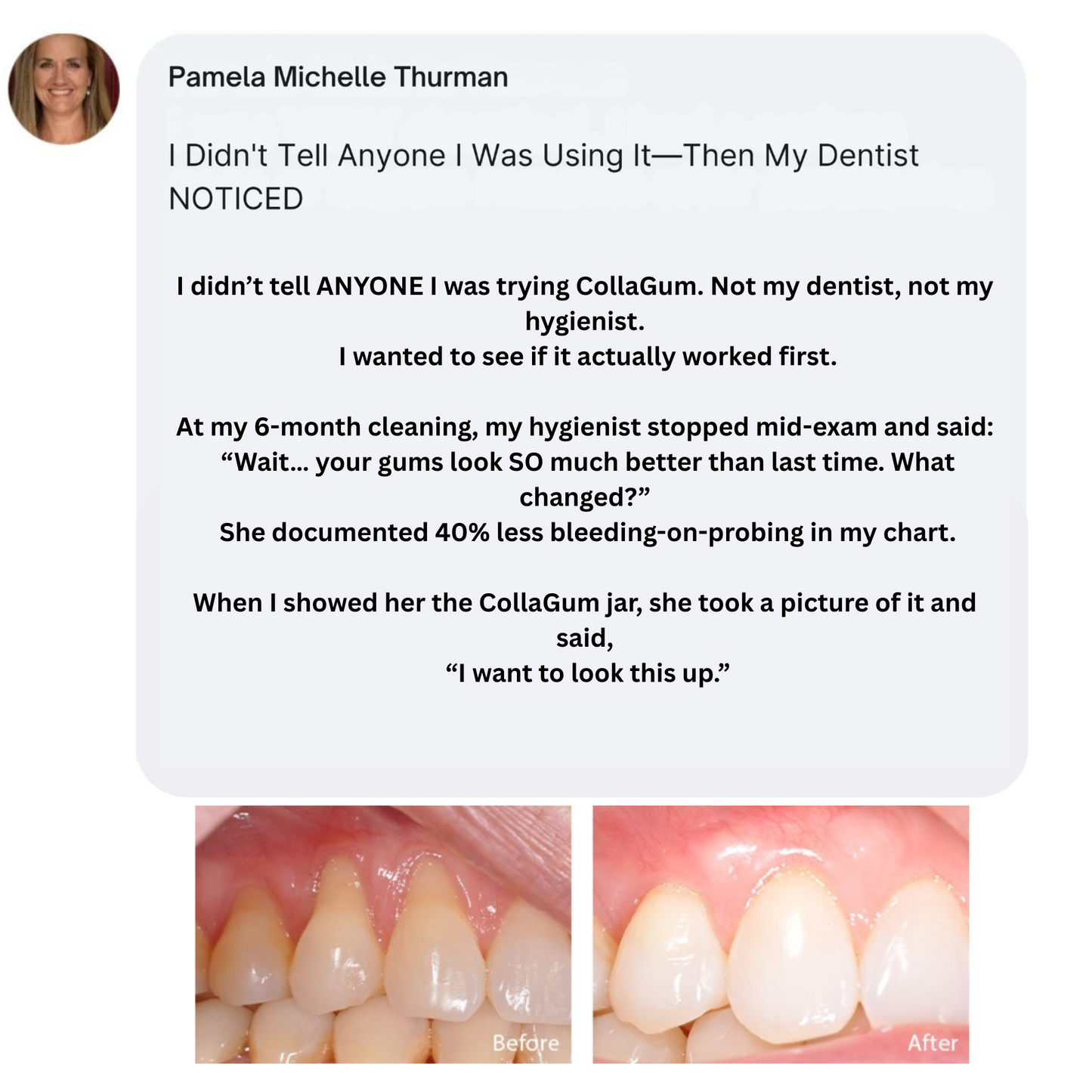 CollaGum | Eat cold food. Drink hot beverages. Smile freely. Stop gum recession—in just 14 days.