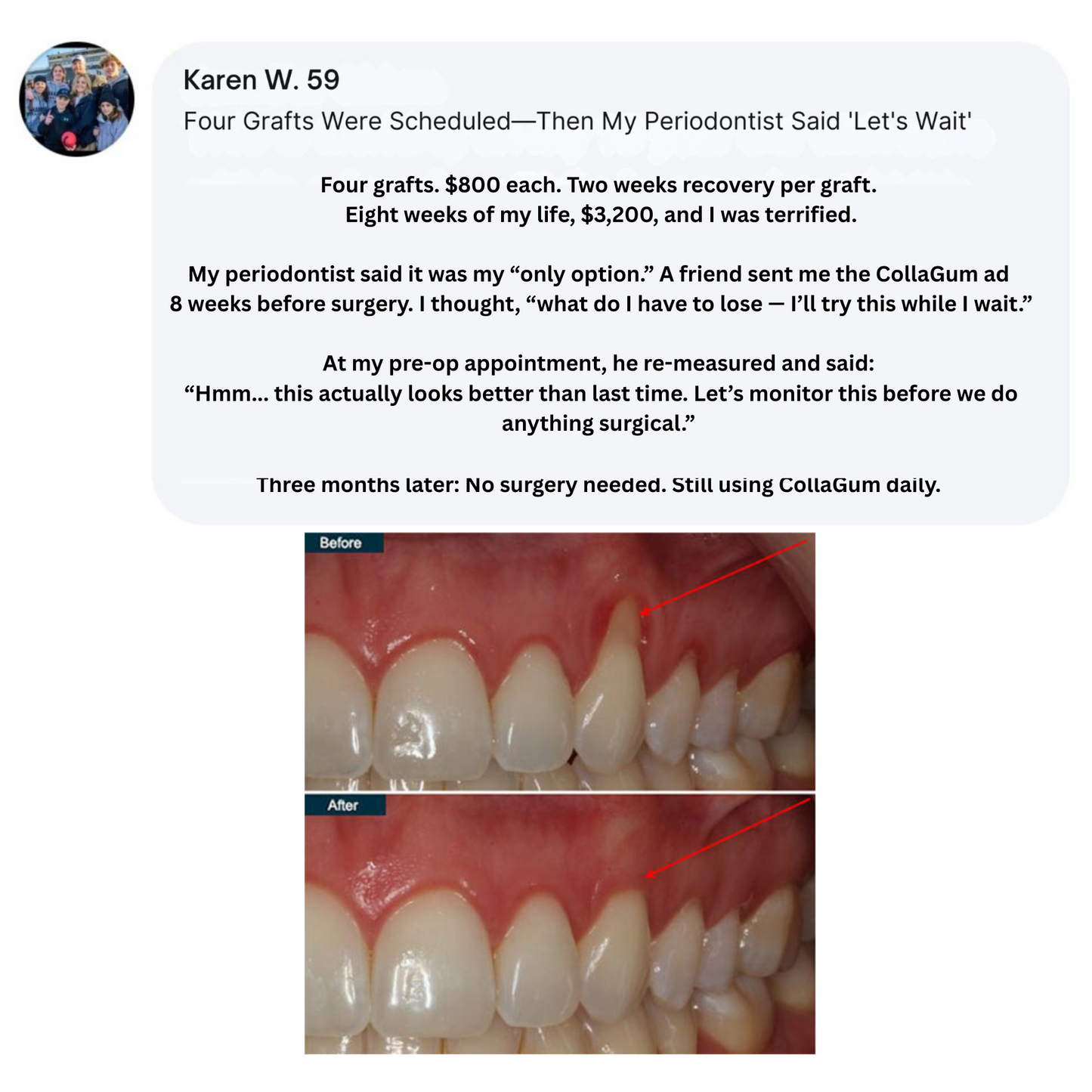 CollaGum | Eat cold food. Drink hot beverages. Smile freely. Stop gum recession—in just 14 days.