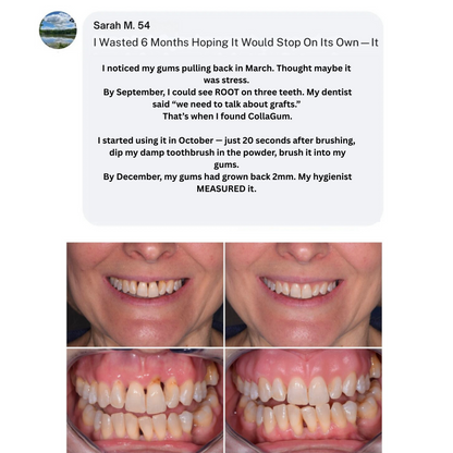 CollaGum | Eat cold food. Drink hot beverages. Smile freely. Stop gum recession—in just 14 days.