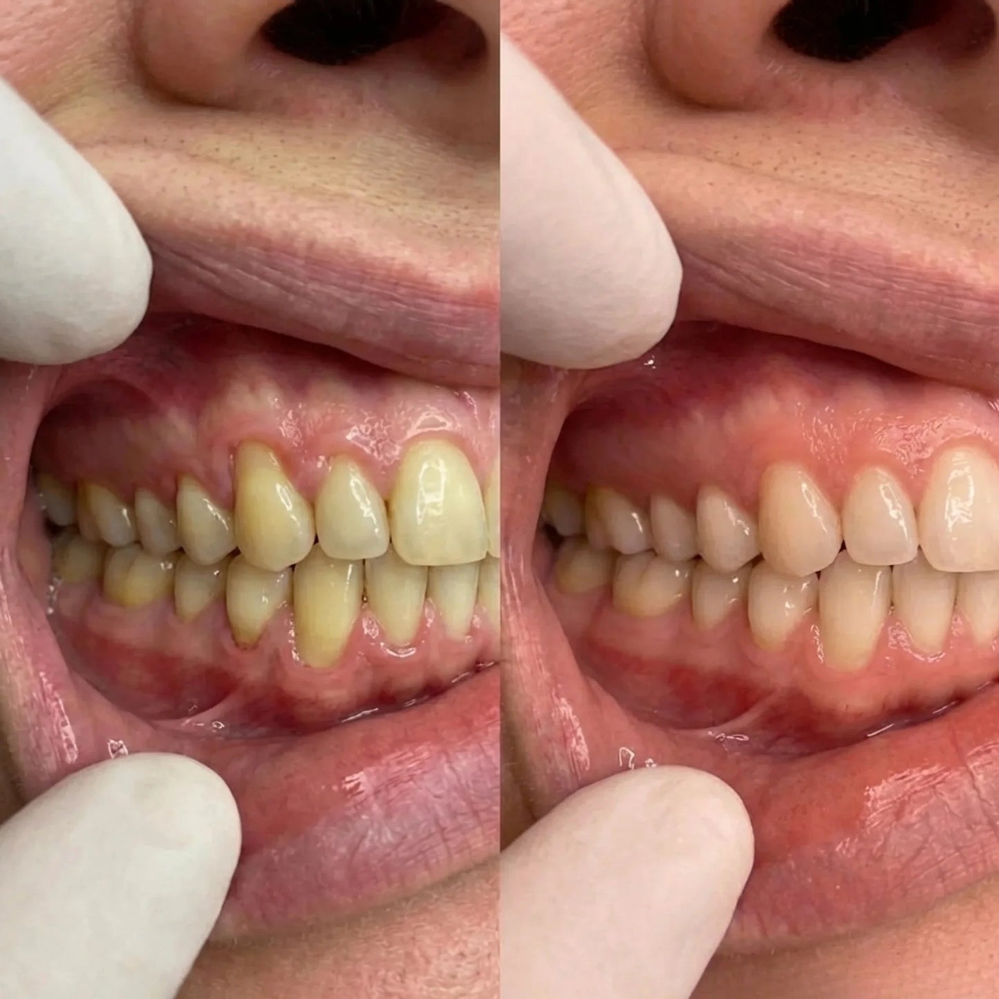 CollaGum | Eat cold food. Drink hot beverages. Smile freely. Stop gum recession—in just 14 days.